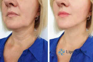 Double chin before and after Hi-Fu treatment 4 Book your double chin treatment Frimley today! We are here to help!