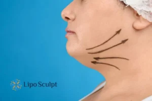 Double chin before and after Hi-Fu treatment 3 Boost your confidence with a Double chin treatment Frimley