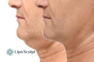 Double chin before and after Hi-Fu treatment 2 Double chin treatment Frimley from Lipo Sculpt - feel more confident today!