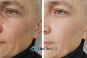 How to Fight Aging Symptoms 3 Fight Aging Symptoms Frimley With HIFU and Morpheus8 Today!