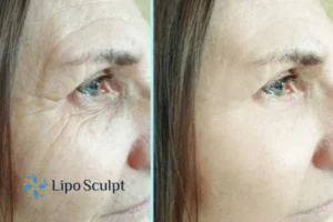 How to Fight Aging Symptoms 2 Do you want to Fight Aging Symptoms Frimley? Contact Lipo Sculpt today!