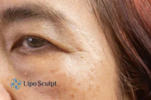 Are age spots Frimley giving you low self esteem? Contact us today!