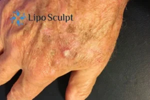 Best Actinic Keratoses Removal 2 Improve your wellbeing and health with Actinic Keratoses Frimley removal.treatment
